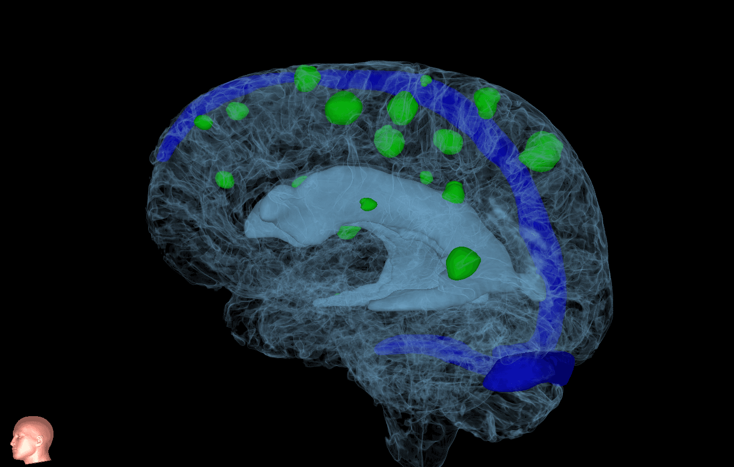 Brain Metastases MRI scan