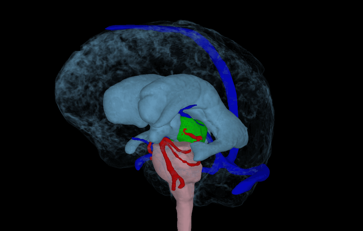 Ependymoma MRI scan