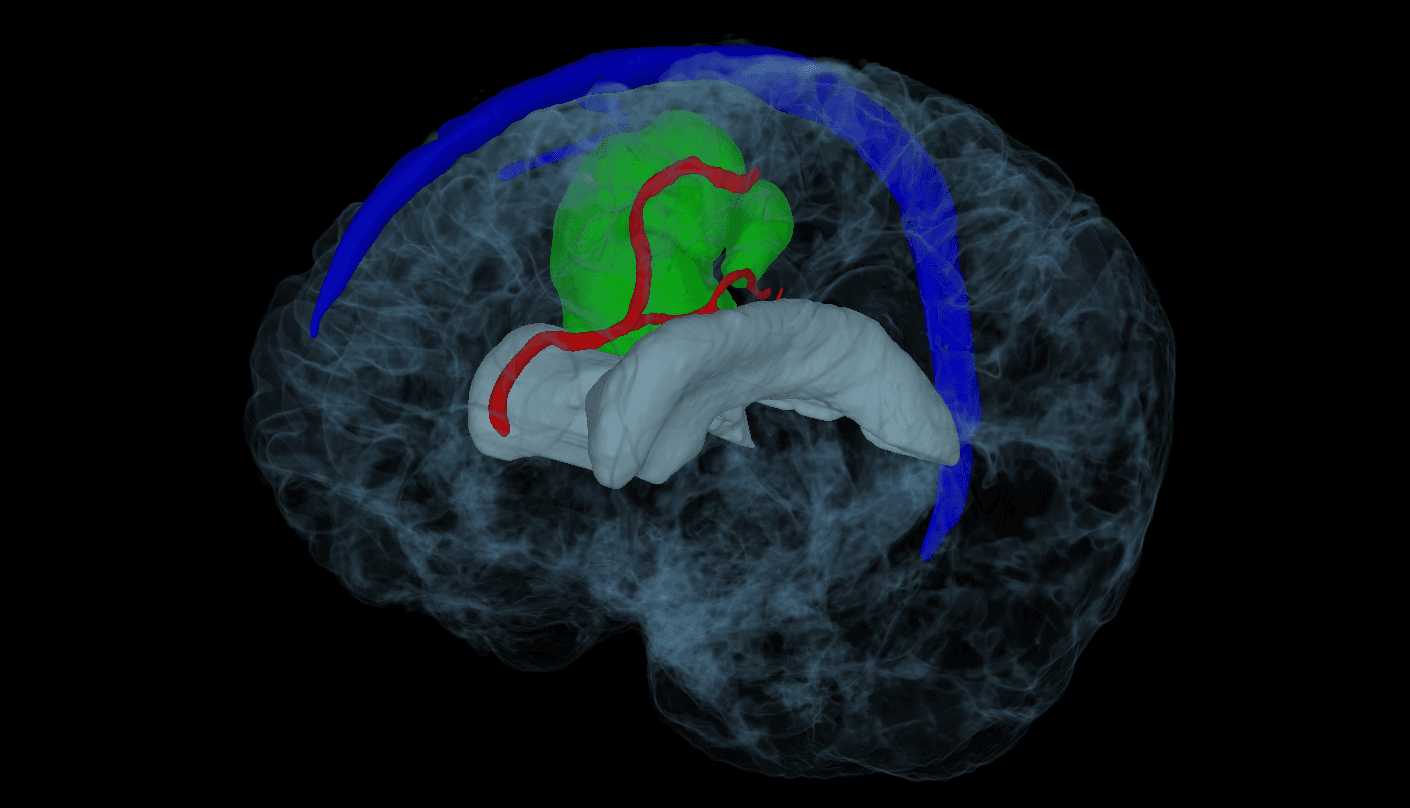 Glioblastoma MRI scan