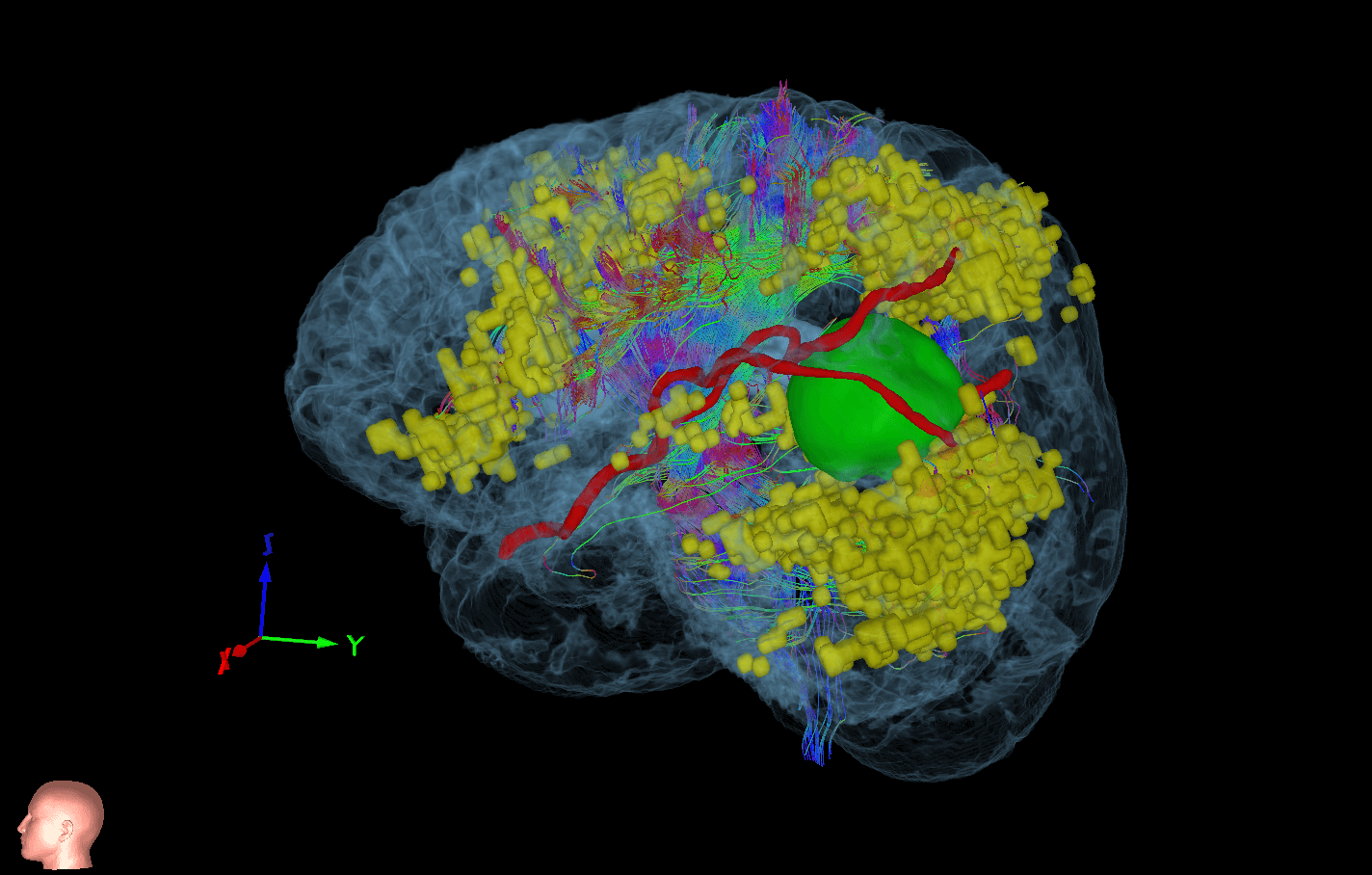High-Grade Glioma MRI scan