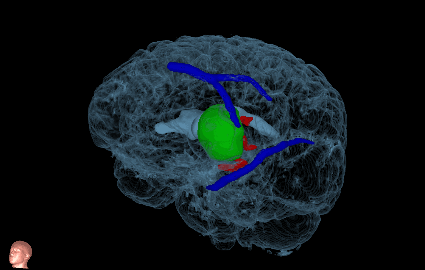 Low-Grade Glioma MRI scan