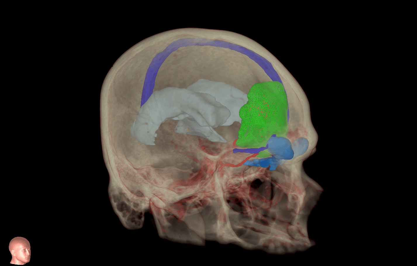 Meningioma MRI scan