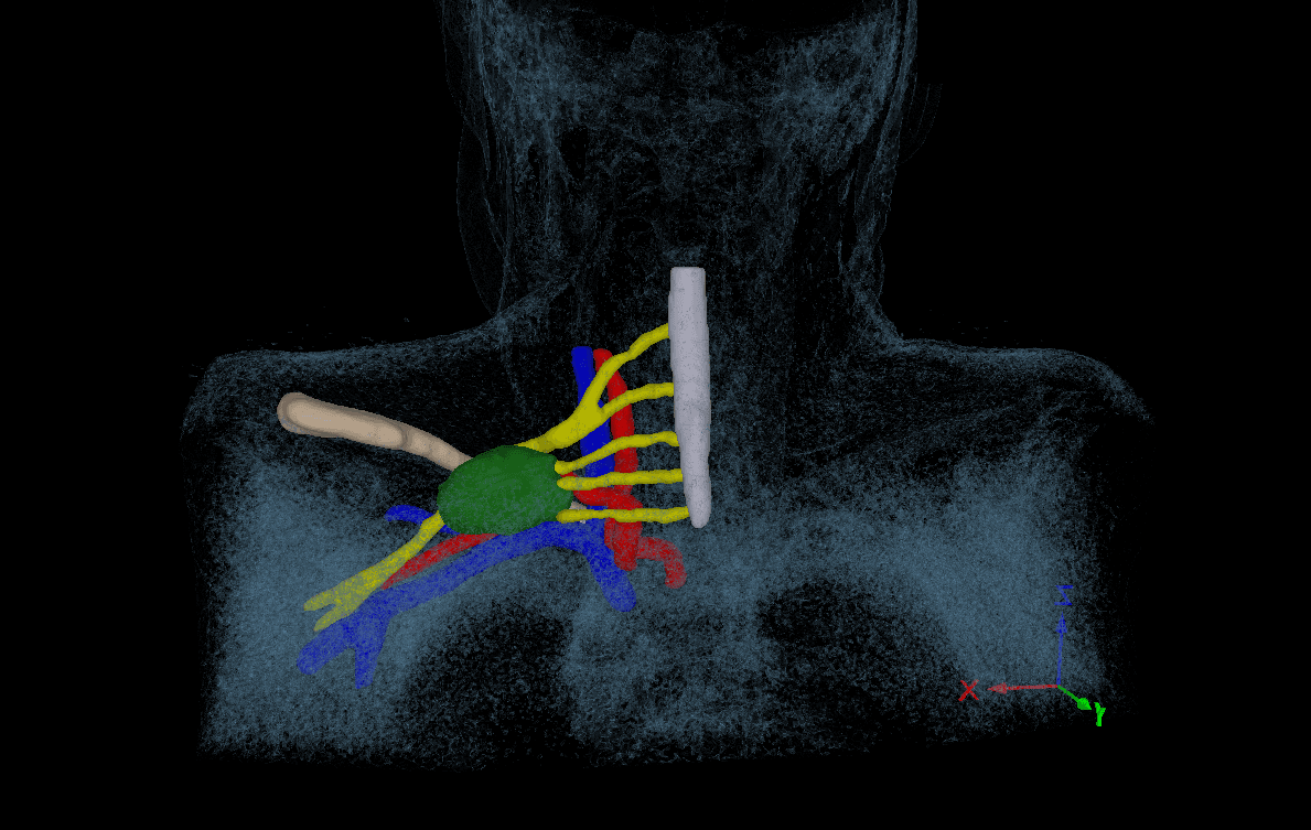 Peripheral Nerve Tumors MRI scan