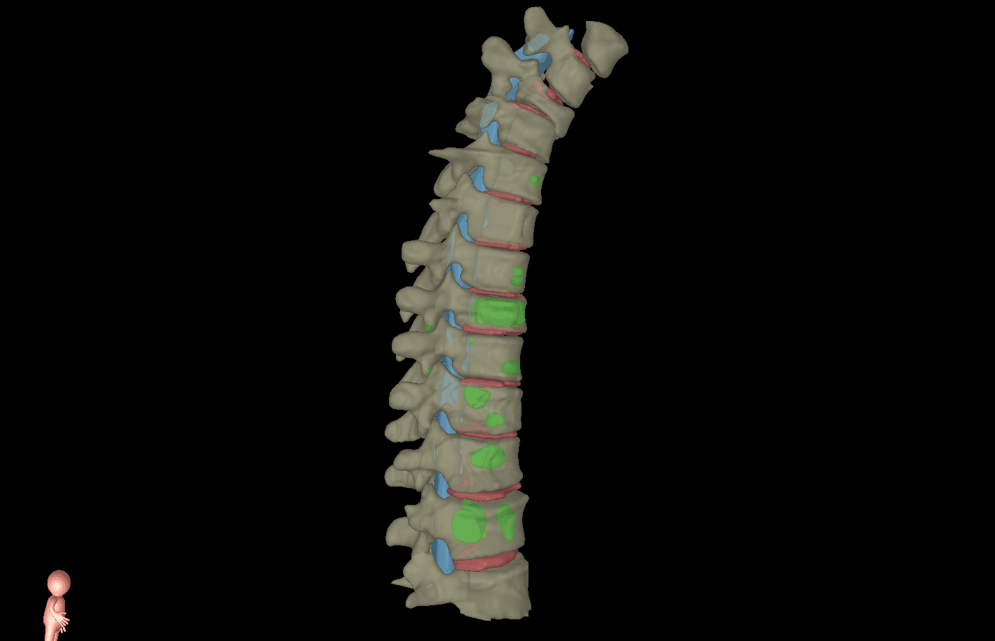 Spine Metastases MRI scan