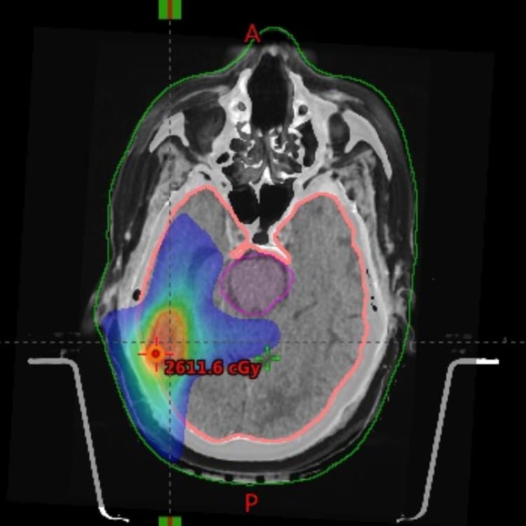 Stereotactic Radiosurgery